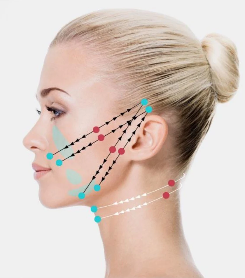 Perfil facial com marcações complementares das áreas tratadas com Fio Silhouette